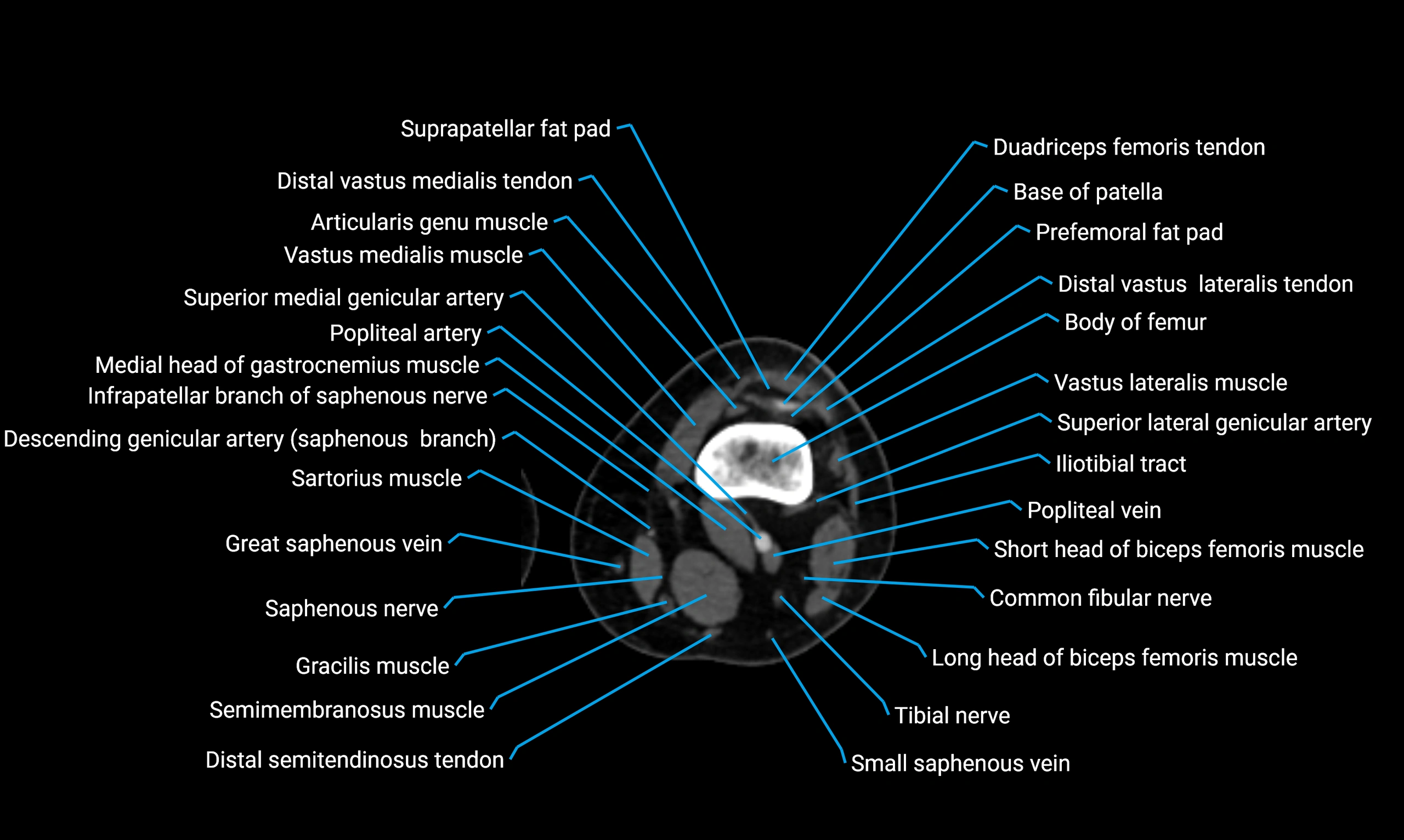 CT lower limb axial cross sectional anatomy labelled image 79 (2).webp